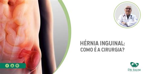 hernia inguinal direta causa